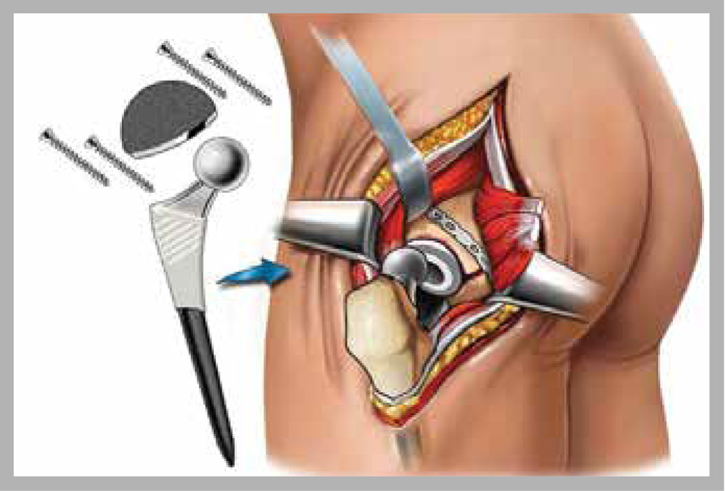 Diagram showing the artificial hip joint and placement within the hip