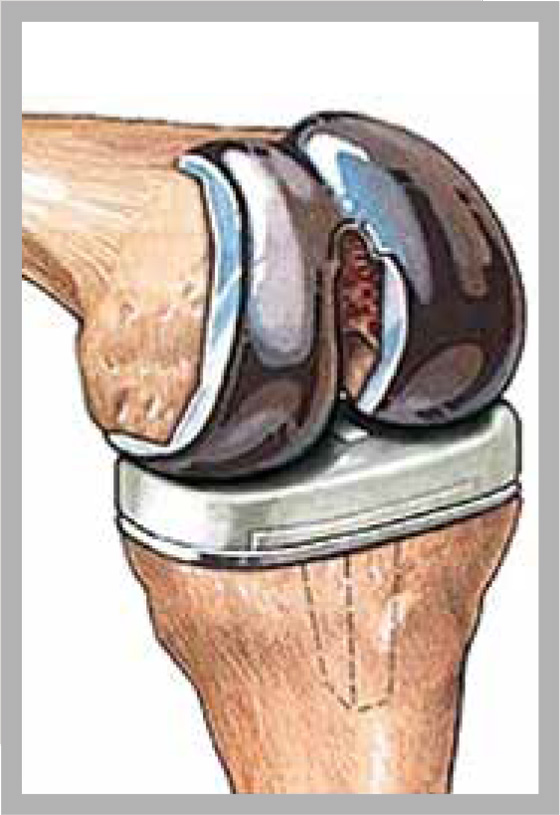 Diagram showing the artificial knee joint and placement within the knee