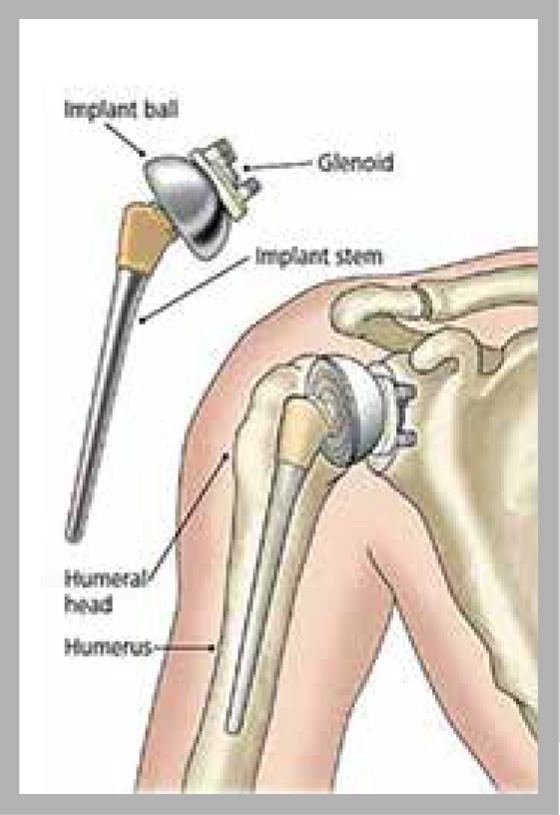 Diagram showing the artificial shoulder joint, it's parts (implant ball, glenoid implant stem, humeral head, humerus) and placement within the shoulder.